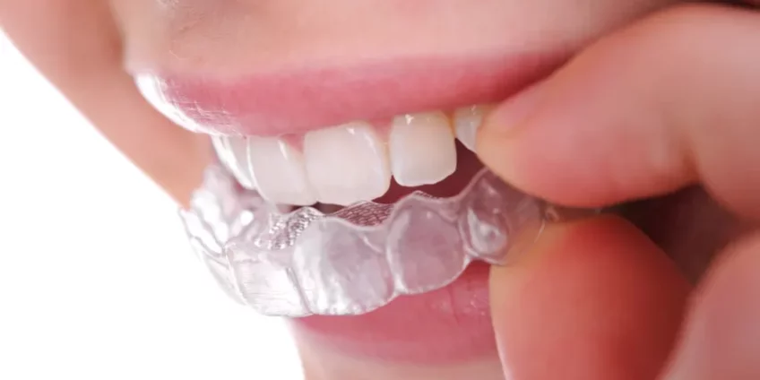 Things You Should Know About Teeth Straightening with Invisalign