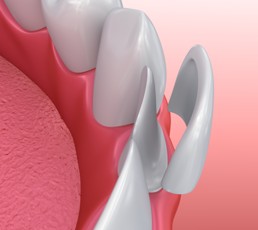 Dental implants with veneers