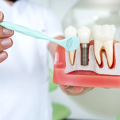 Detailed Guide to Cleaning Dental Implants